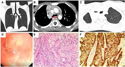 Pulmonary mucoepidermoid carcinoma in children: two case reports and a review of the literature